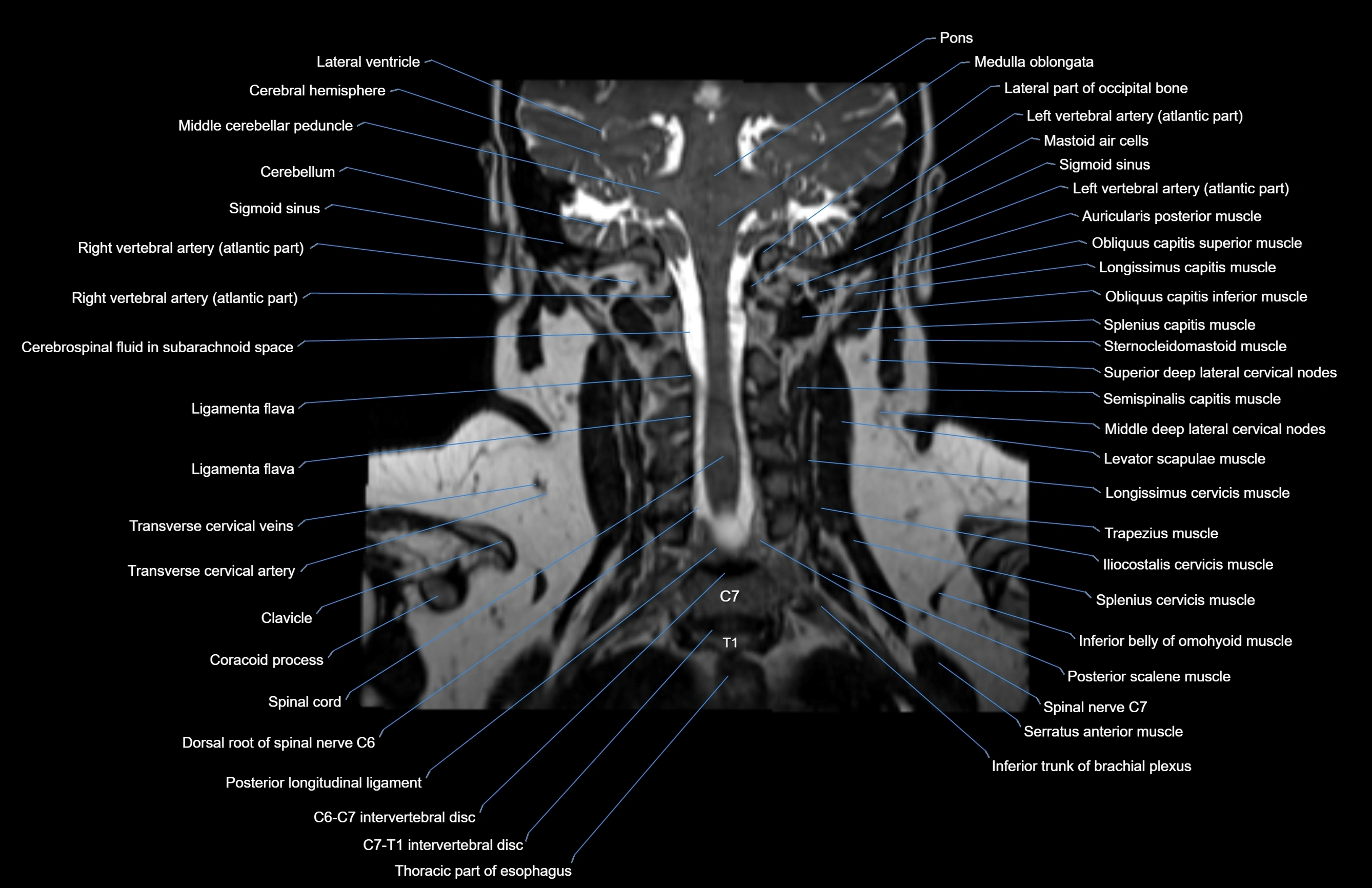 Neck coronal cross sectional MRI anatomy 3T MRI  image-img-00001-00023.webp